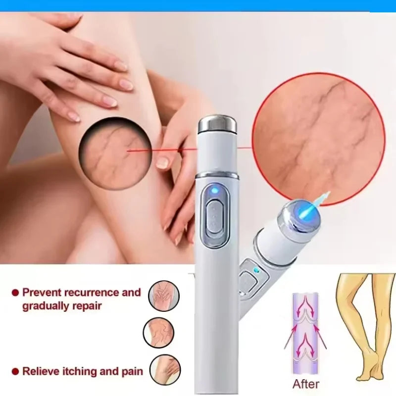 Blue light therapy pen for spider veins
