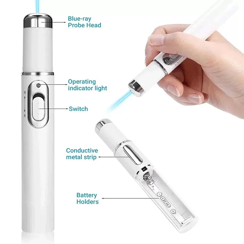 Blue light therapy pen for spider veins